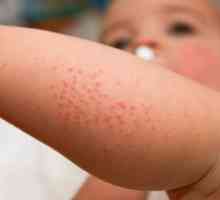 Prehrana pri otrocih z atopijskim dermatitisom