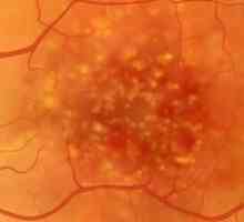 Distrofija mrežnice: kaj je to, simptomi bolezni