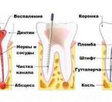 Dolge zobne bolečine po odstranitvi živca