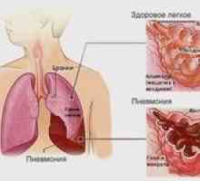 Dvostranska pljučnica: kako zdraviti pljučnico?