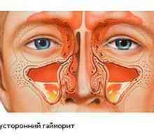 Dvostranski sinusitis pri otroku in odraslih