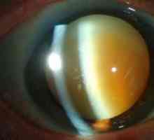 Fakoskleroza očesne leče: kako zdraviti in kaj je to?