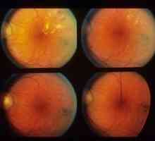 Ozadje retinopatije in vaskularnih sprememb mrežnice