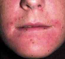 Fotografija perioralnega dermatitisa, zdravljenja bolezni