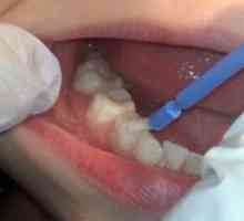 Fluorizacija zob pri otrocih - jamstvo za zdravo ugriz