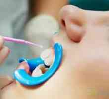 Fluorizacija zob pri otrocih: ugodnost, cena
