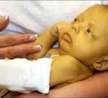 Hemolitična bolezen novorojenčkov (GBH)