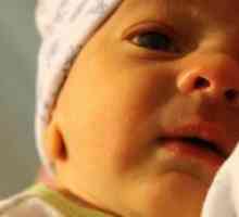 Hemolitična zlatenica pri novorojenčkih