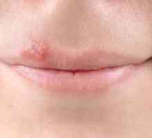 Herpes na ustnici: vzroki, simptomi in zdravljenje