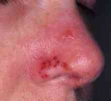 Herpes na nosu: metode za zdravljenje prehladov, fotografija