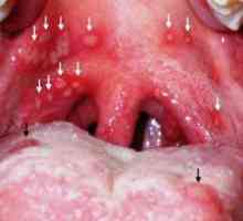 Herpes vneto grlo: simptomi in zdravljenje