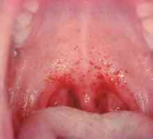 Herpes stomatitis pri otrocih: simptomi in zdravljenje