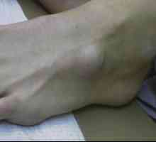 Hygroma na prstih in dviganje stopala: simptomi in zdravljenje