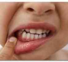 Gingivitis pri otrocih: oblike bolezni dlesni