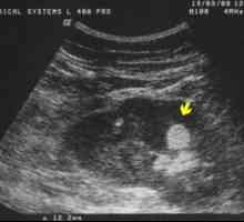 Hiperehoične oblike z ledvičnim ultrazvokom