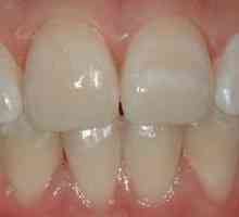 Hipoplazija emajla dojenčkov: zobje zobje