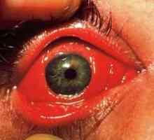 Mastno oko iz konjunktivitisa pri otroku in odraslih