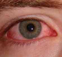 Očesne masti za konjunktivitis za otroke