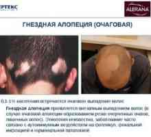 Alopecia areata pri ženskah in njeno zdravljenje