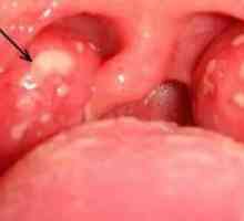 Razjede v grlu brez temperature, kako zdraviti absces?
