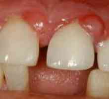 Zobna granuloma: simptomi in zdravljenje bolezni