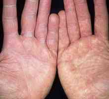 Gobe ​​na prstih: simptomi in fotografija bolezni
