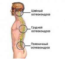 Chondroza vratne hrbtenice: simptomi in zdravljenje