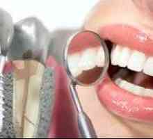 Implantacija zob pod ključem: cena implantacije zoba pod ključem