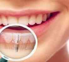 Vpliv zob: bistvo postopka za postavitev zobnega vsadka