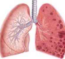 Emfizem pljuč - kaj je to in napoved življenja