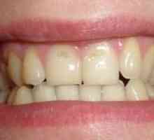 Erozija zobnega emajla: vzroki, simptomi, zdravljenje