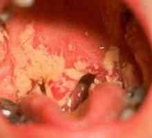 Kako se znebiti drobovja v ustih odraslega?