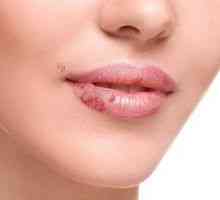 Kako zdraviti cheilitis na ustnicah odraslih in otrok