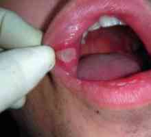 Kako zdraviti vnetje ustne sluznice: sredstva in metode zdravljenja