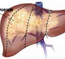 Kako prepoznati jetrni rak: prvi znaki in simptomi