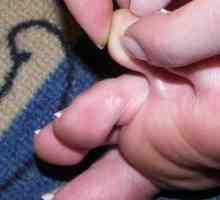 Kako odstraniti kaluse iz prstov