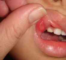 Kakšno zdravilo lahko izbirate med stomatitisom v ustih?
