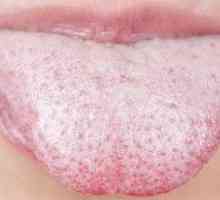Kandidija ustne votline: zdravljenje ust za odrasle