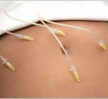 Karboksiterapija - plinske injekcije za hrbet, sklepe in obraz
