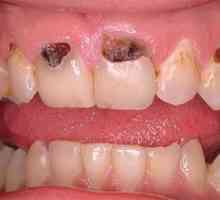 Karies prednjih zob: vzroki in zdravljenje bolezni