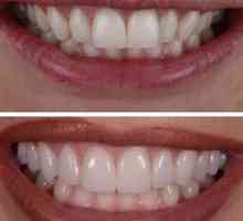 Keramična obloga za zobe: opis in navedbe