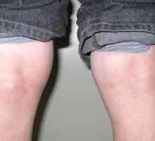 Beckerjeva cista pod kolenom - kako nevarna in kako zdraviti?