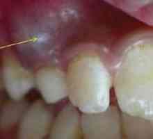 Cista na korenu zoba: vse metode odstranitve