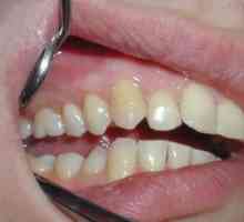 Cista na zob: vzroki, simptomi in zdravljenje bolezni