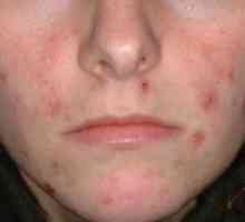 Klinična slika in zdravljenje demodexa na obrazu