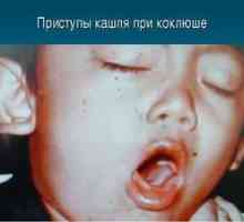 Pertusis pri otrocih: simptomi in zdravljenje
