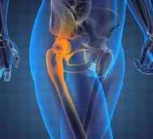 Koksartroza kolčnega sklepa: simptomi in zdravljenje