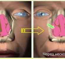 Konhobuloza (hipertrofija nosne conhe): kaj je to?