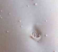 Molluscum contagiosum na koži otroka: zdravljenje in fotografije