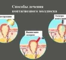 Molluscum contagiosum na koži otroka: simptomi, diagnoza, zdravljenje